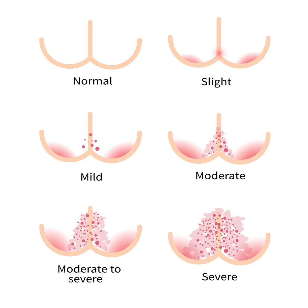 diaper rash in babies