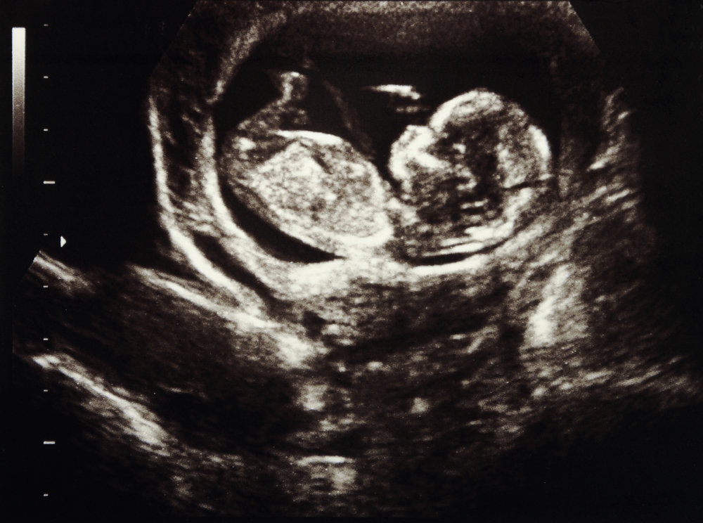human baby ultrasound pregnancy week 11