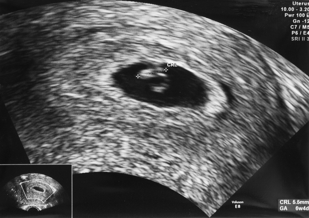 ultrasound scan baby pregnancy week 6