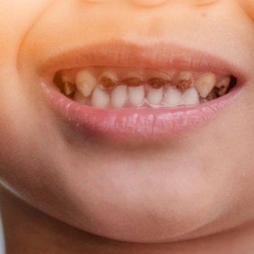 tooth decay in children